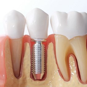 dental implant model in Rocky Hill