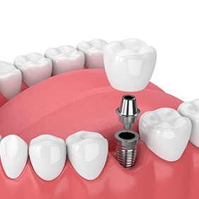 3D rendering of dental implant in Rocky Hill