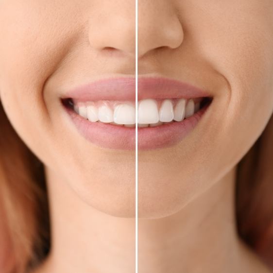 Smile before and after gum recontouring