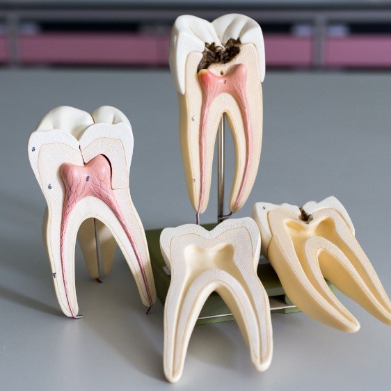 Model of healthy tooth compared to tooth in need of root canal therapy
