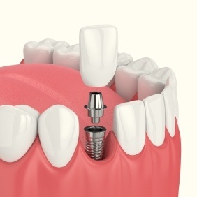 Animated dental implant supported dental crown placement