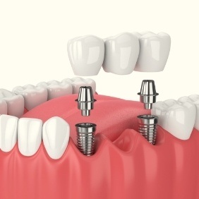 Animated dental implant supported fixed bridge placement