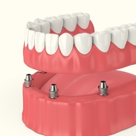 Animated dental implant supported denture