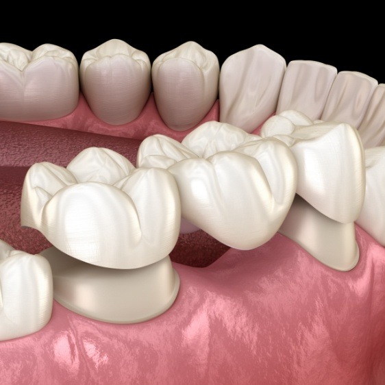 Animated smile during dental bridge placement