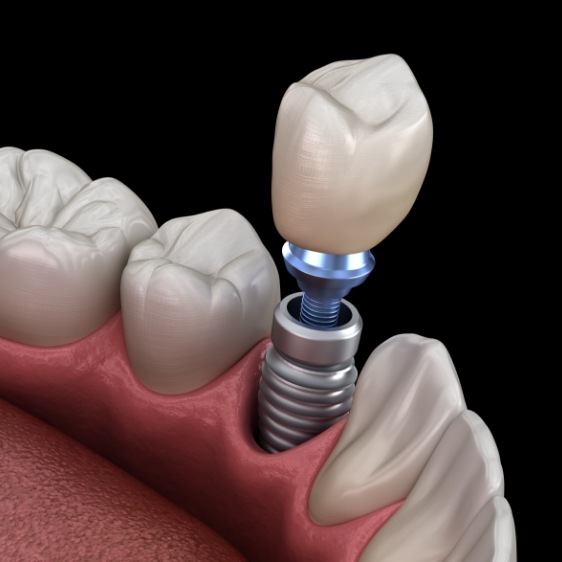 Animated smile with dental implant supported dental crown