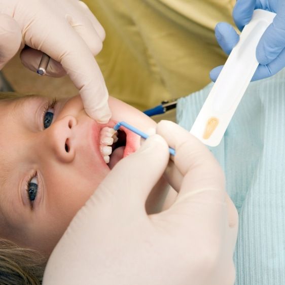 Child receiving silver diamine fluoride treatment