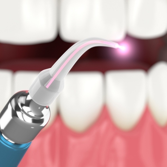 Laser gum disease treatment tool