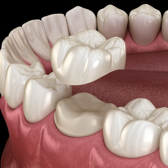 Animated smile during dental crown placement